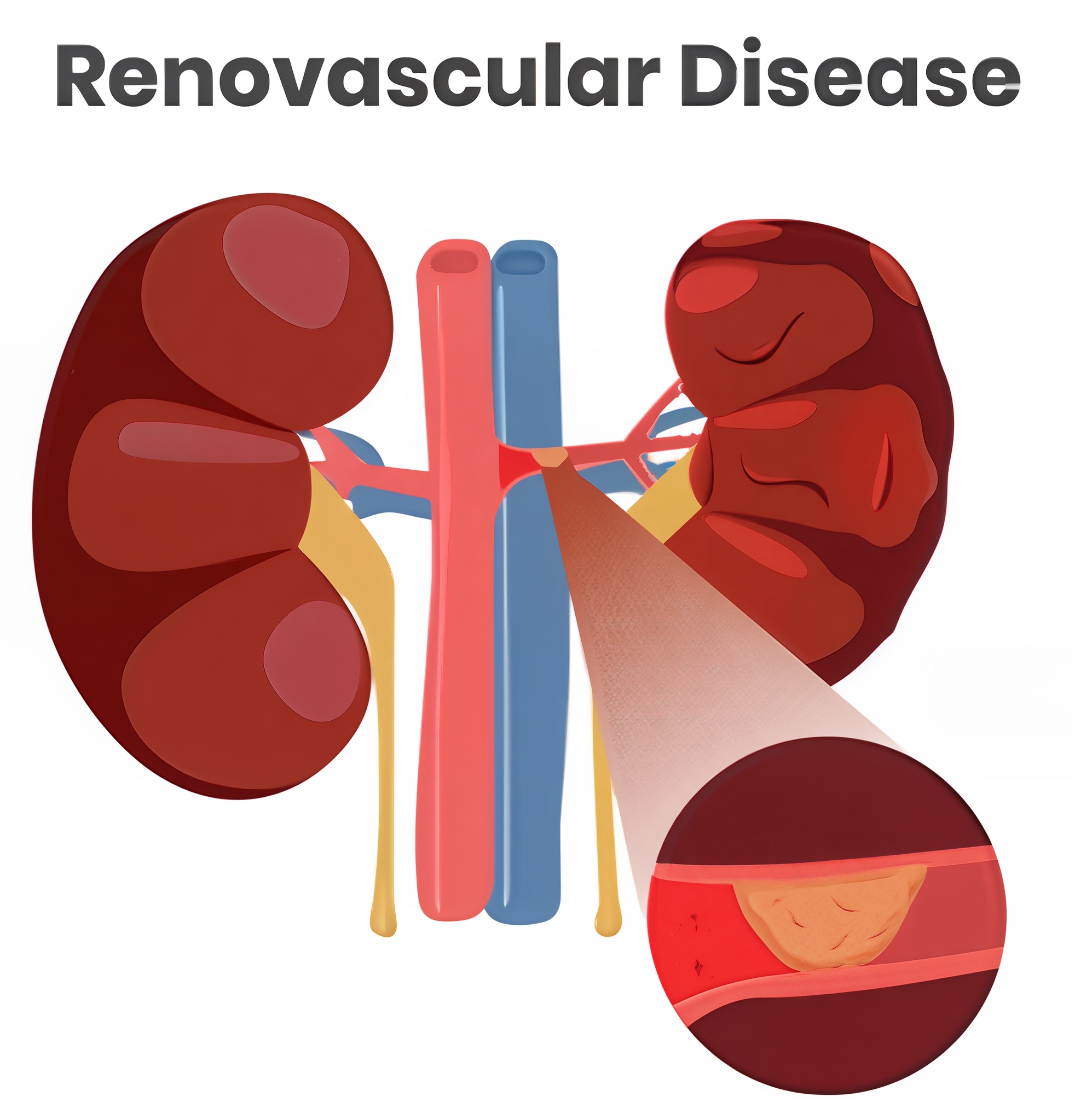 Renal artery stenosis