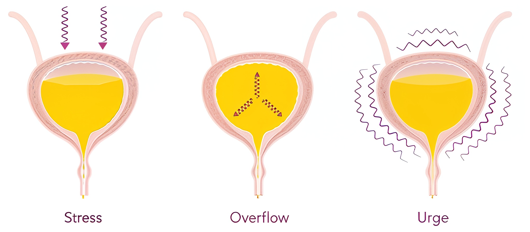 Urinary Incontinence (2)
