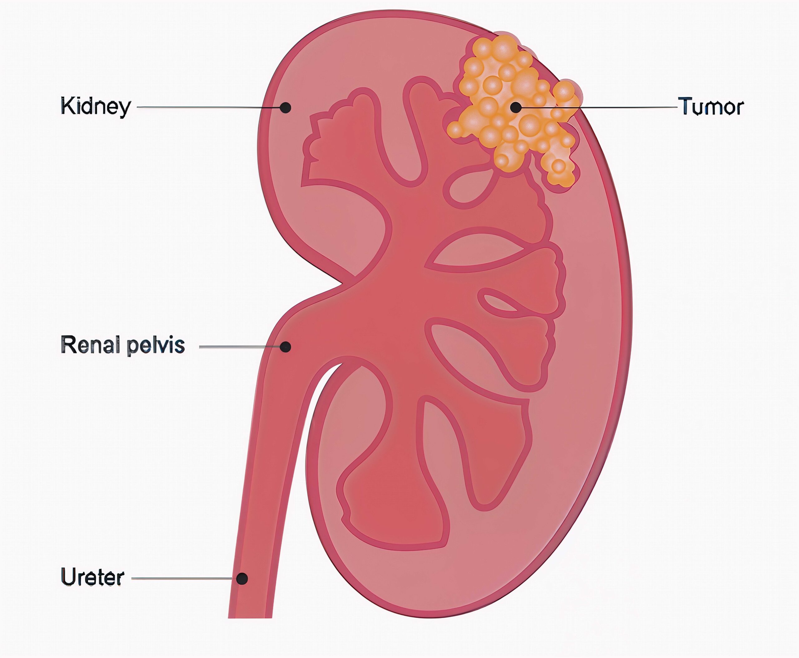 kidney cancer (2)