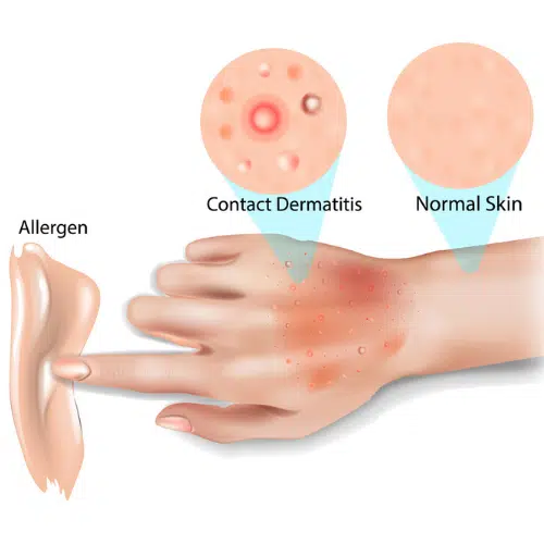 Contact-Dermatitis-Dr-Colin-Hong