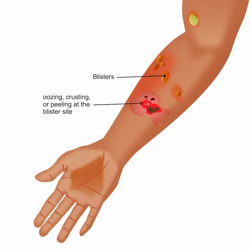 Pemphigus Vulgaris Overview and Management