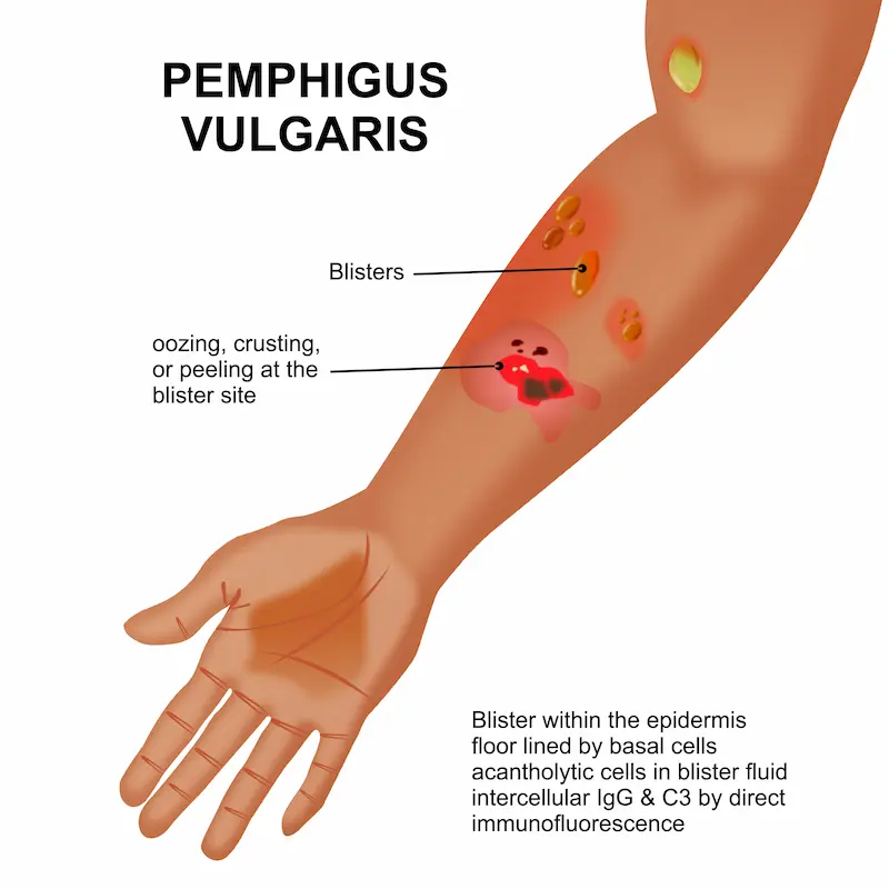 Pemphigus Vulgaris Overview and Management