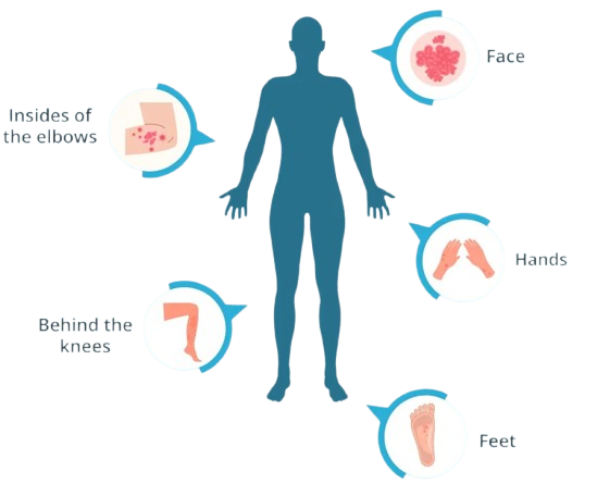 eczema-removebg-preview