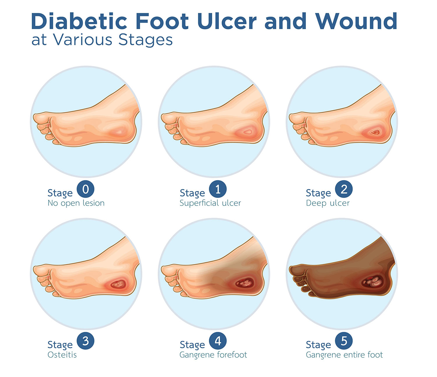 Diabetes – foot ulcers