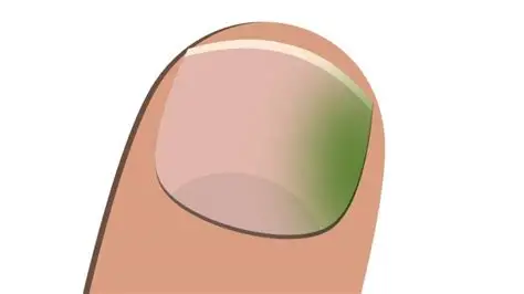 Green nail syndrome