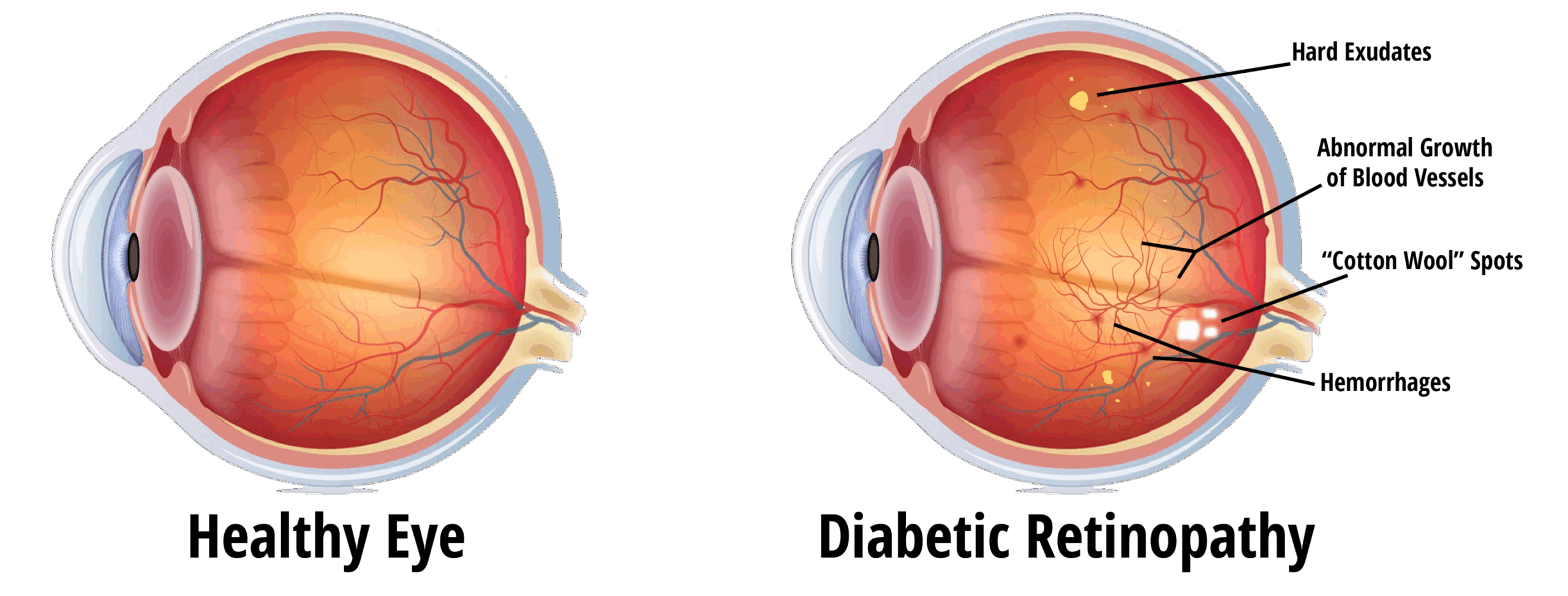 Diabetic Eye Disease