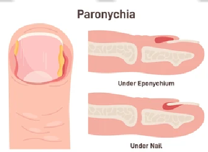 Paronychia