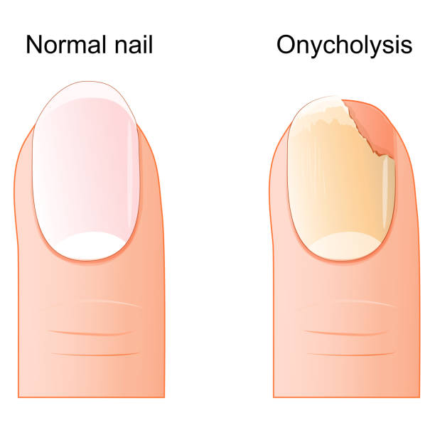 NORMAL VS. Nail Lifting (Onycholysis)