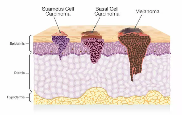 types-of-skin-cancer
