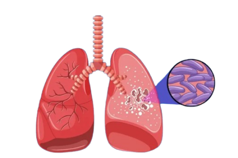Ultrasensitive test reveals evidence of previously undetected tuberculosis in hospital patients