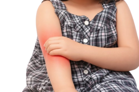 Recommendations Developed for Prevention of Pediatric Atopic Dermatitis
